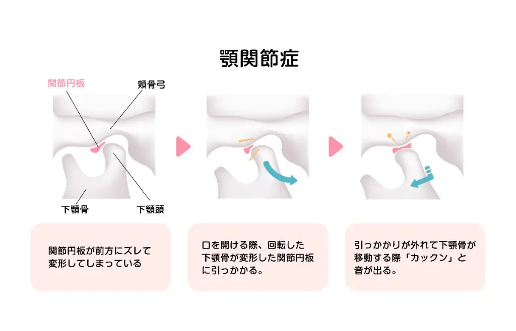 顎関節症とは