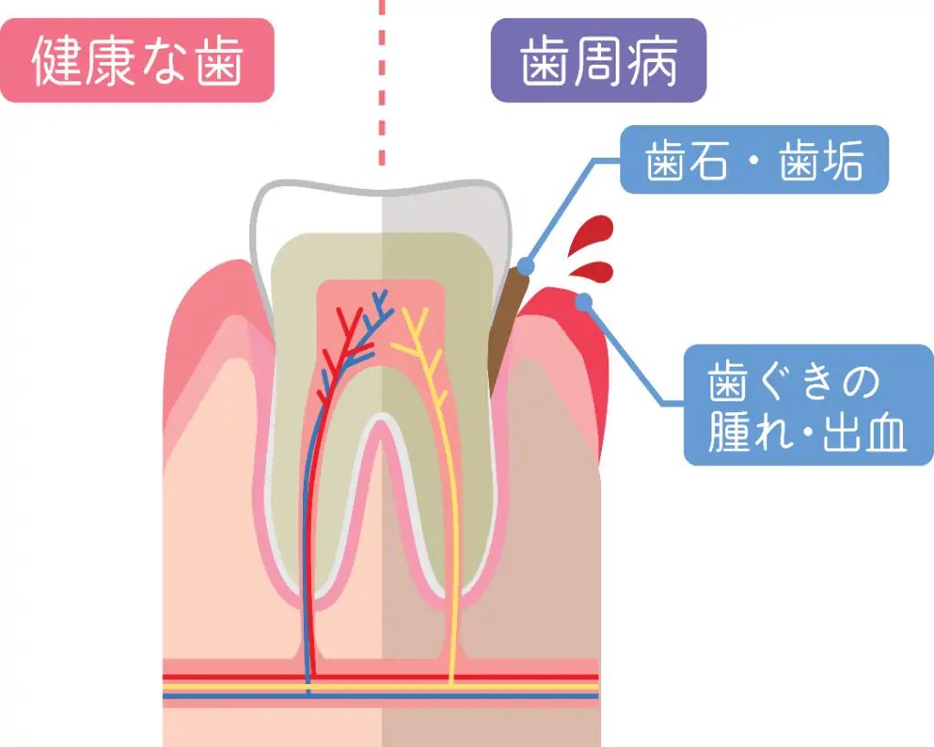 歯周病とは