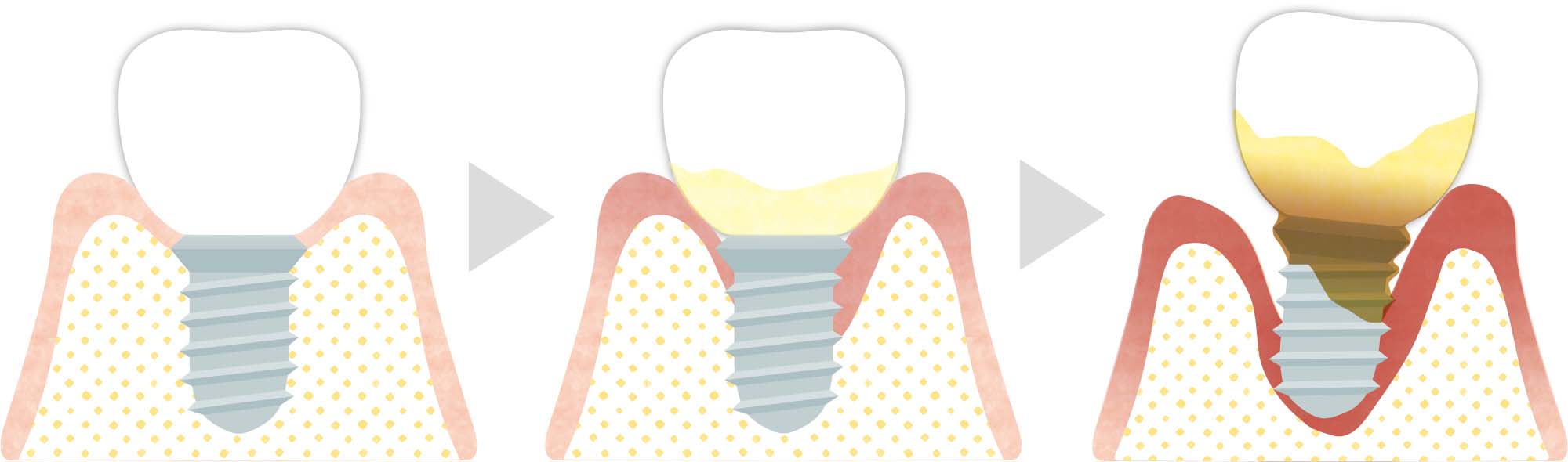 インプラント周囲炎が進行する様子