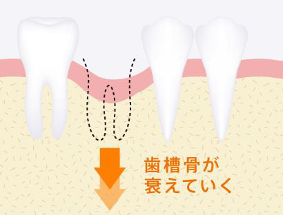 抜けた歯と噛み合っていた歯が伸びて出てしまうケース