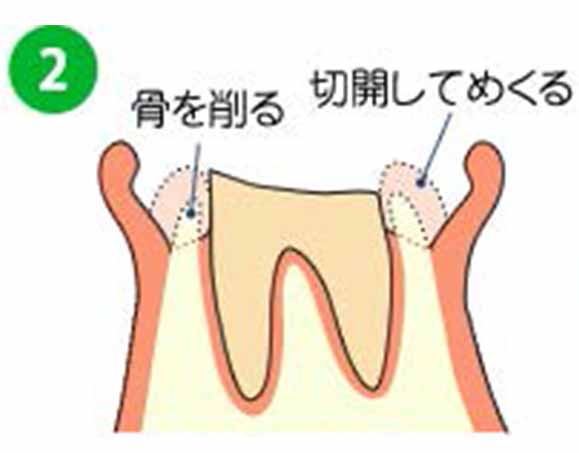 埋もれた歯の根の一部を露出させます