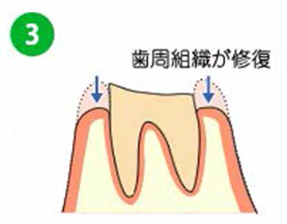 被せものの土台が確保できます