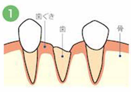 歯の根の部分だけが残っています