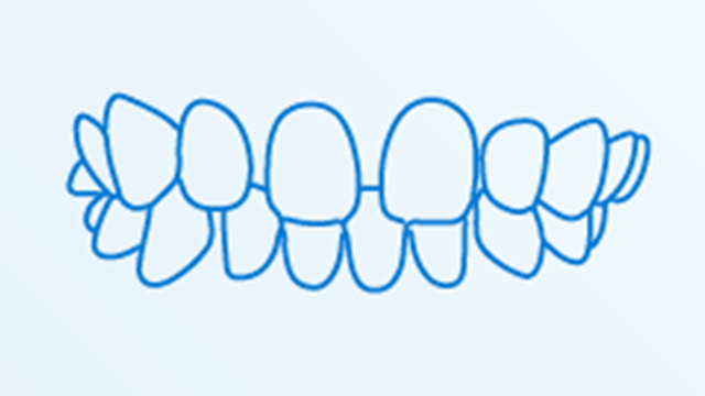 空隙歯列（くうげきしれつ）
