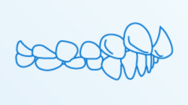 マウスピース矯正による出っ歯の治療