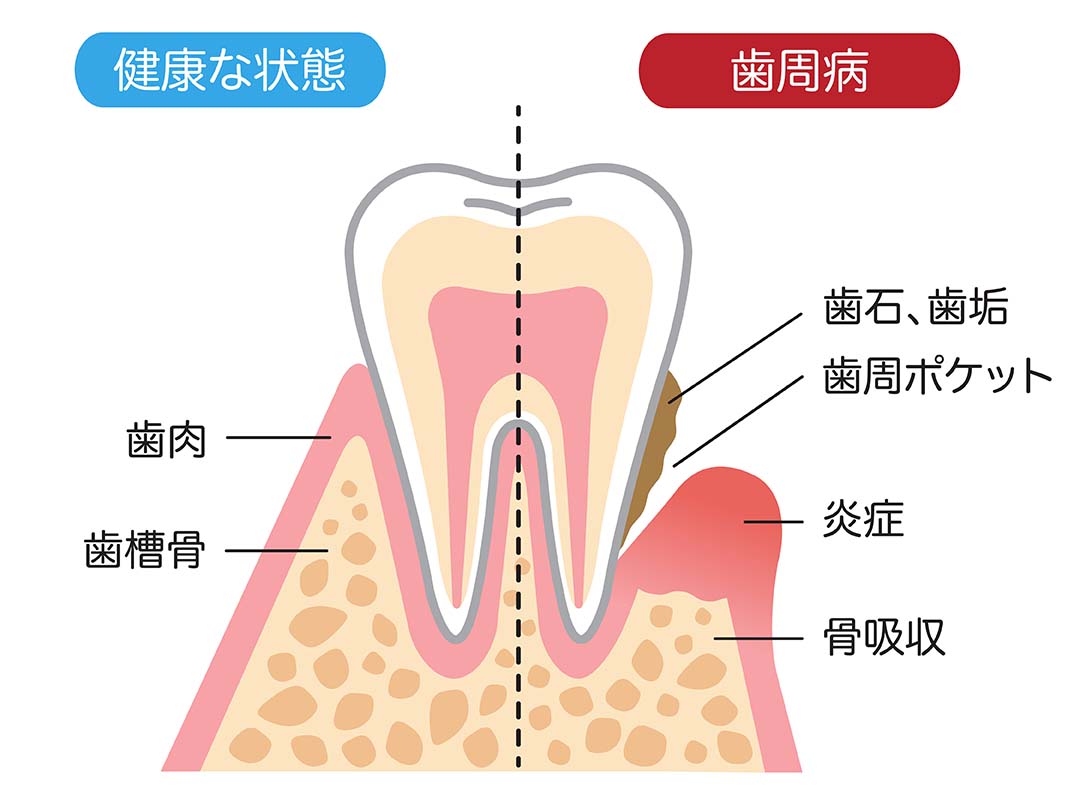 歯周病の症状