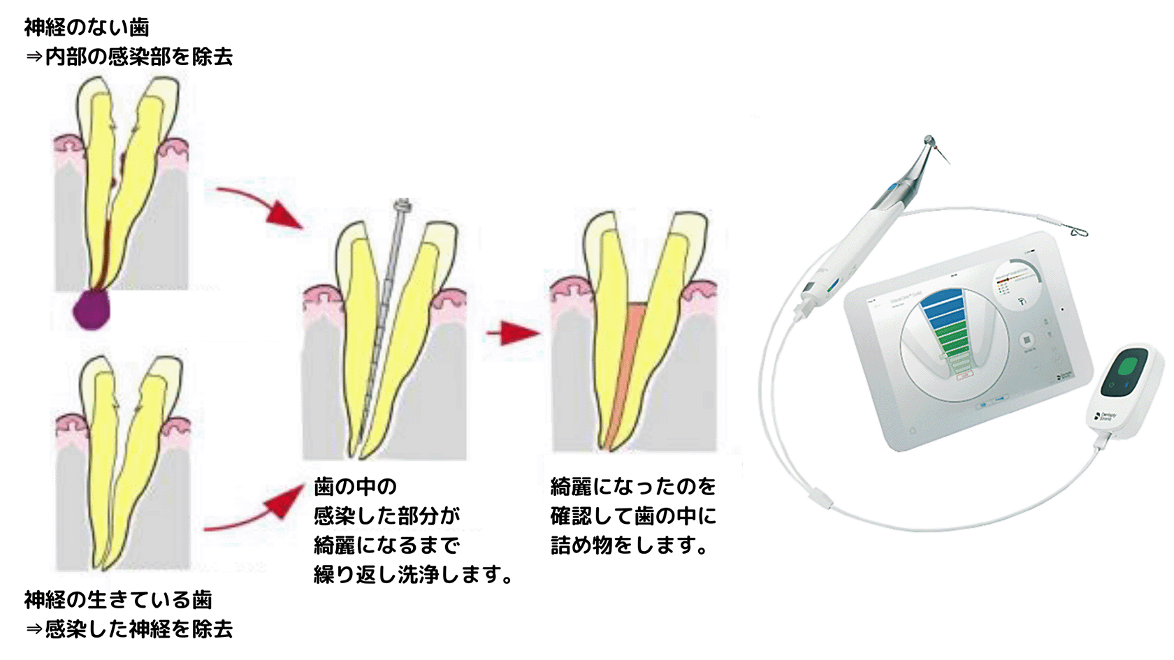 神経のない歯