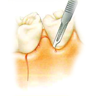 歯肉の切開