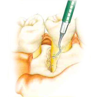 歯根表面の清掃