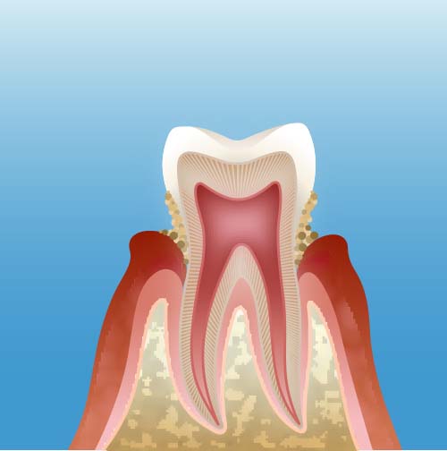 初期歯周病