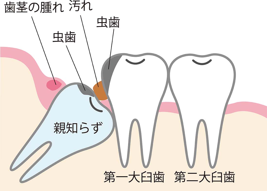 親知らず